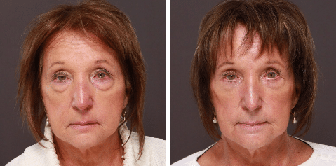 Utah Facial Plastics lower blepharoplasty eyelid lift